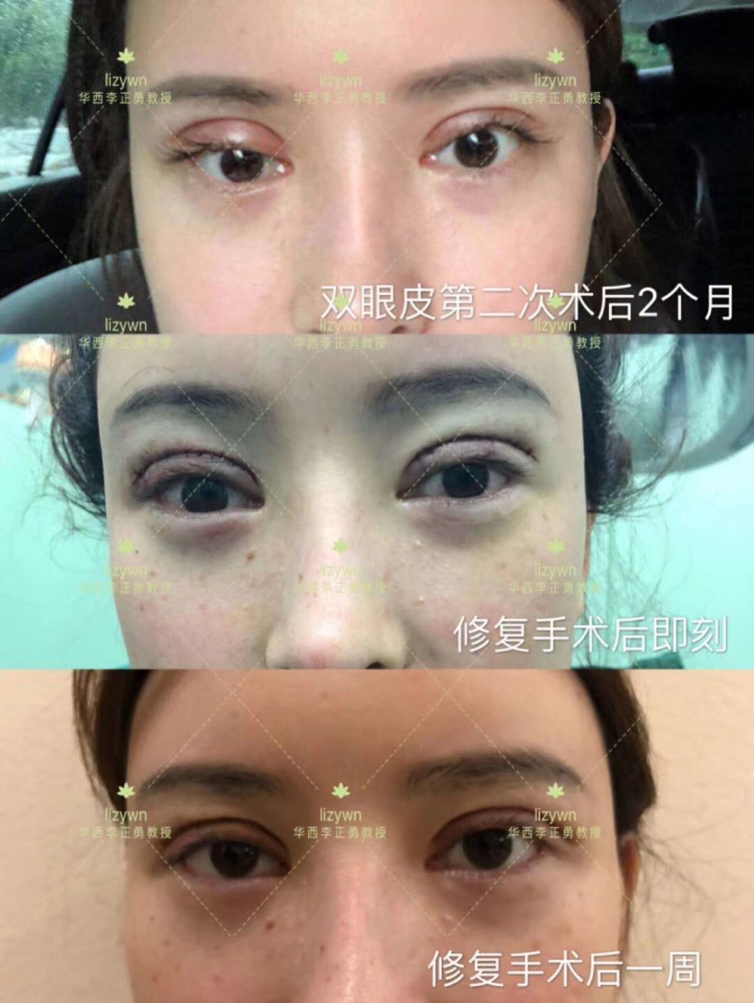 五年双眼皮不成功？三点定位解决！