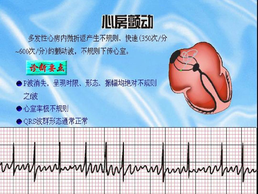 阵发性室上性心动过扑_阵发性心房扑动的治疗_阵发心房扑动