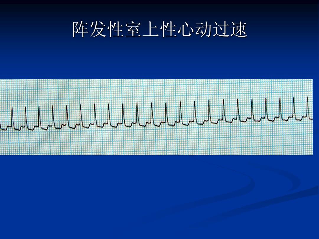 雷过扑该喊嘎产_阵发性室上性心动过扑_虎扑旧城大神发过的图