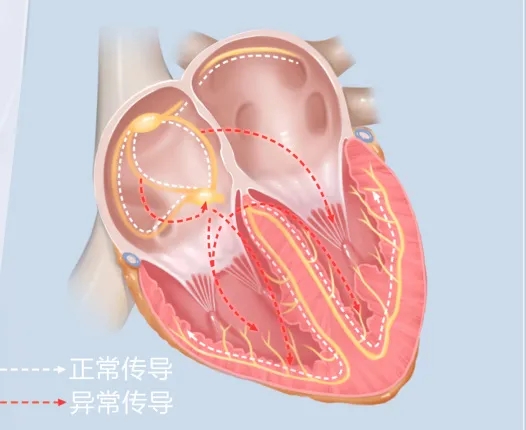 阵发性心房扑动吃什么药_阵发性室上性心动过扑_阵发心房扑动