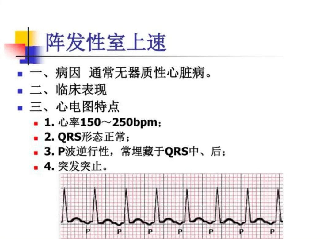 阵发性室性心动过_阵发性房性心动_阵发性室上性心动过速治疗