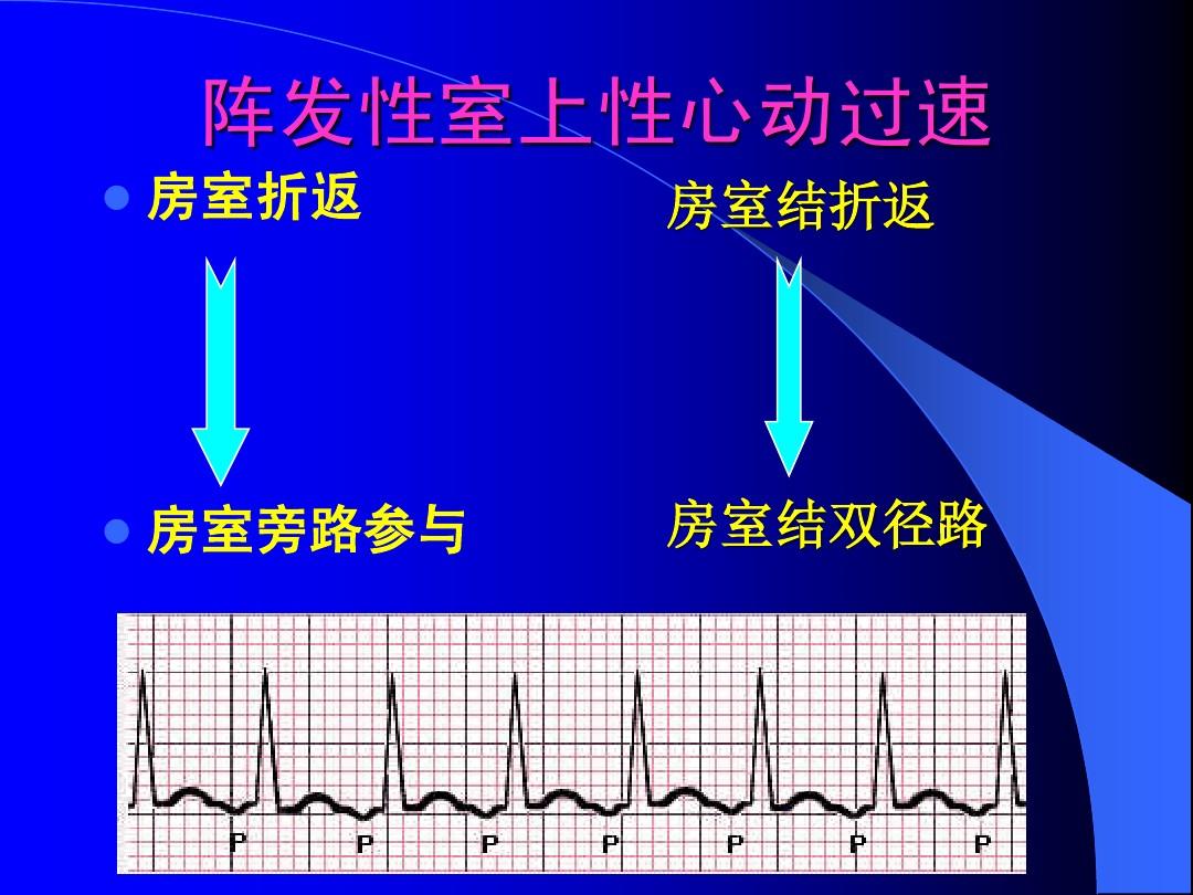 阵发性室上性心动过速治疗_阵发性室性心动过_阵发性房性心动